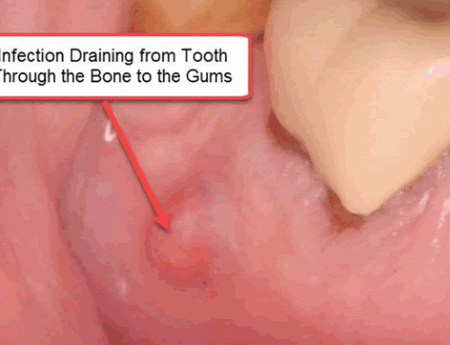 Dental infections destroy mitochondria